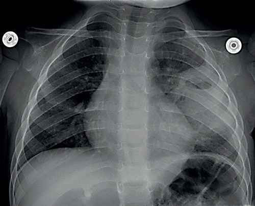 Radiografía de tórax (neumonía redonda izquierda con necrosis central)